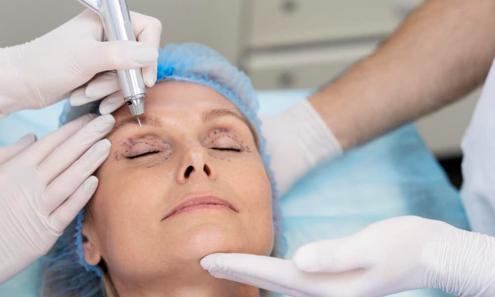 Read more about the article If you have suffered a poorly done blepharoplasty, here are the possible solutions